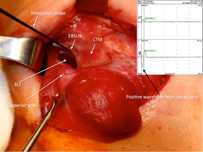 Intraoperative cricothyroid muscle electromyography may contribute to the monitorization of the external branch of the superior laryngeal nerve during thyroidectomy